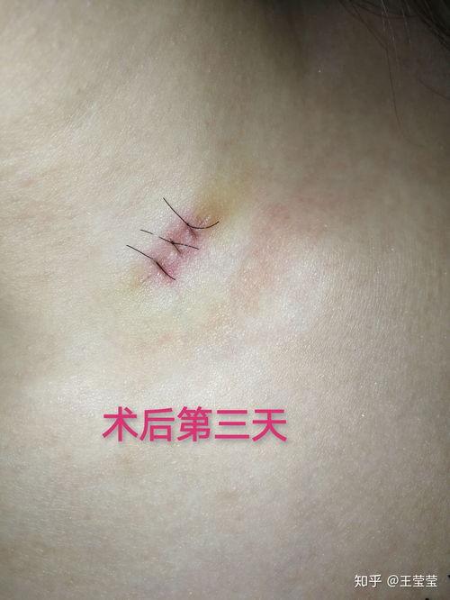 黑痣切除手术视频,专业操作与术后护理指南