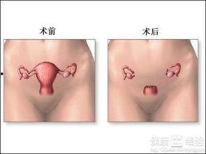 子宫全切视频教程,子宫全切手术操作步骤详解